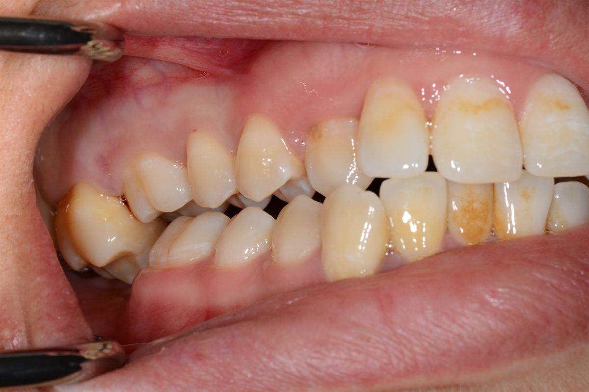 Vue en bouche d'une égression : la dent privée d'antagoniste est descendue sous le niveau des dents voisines