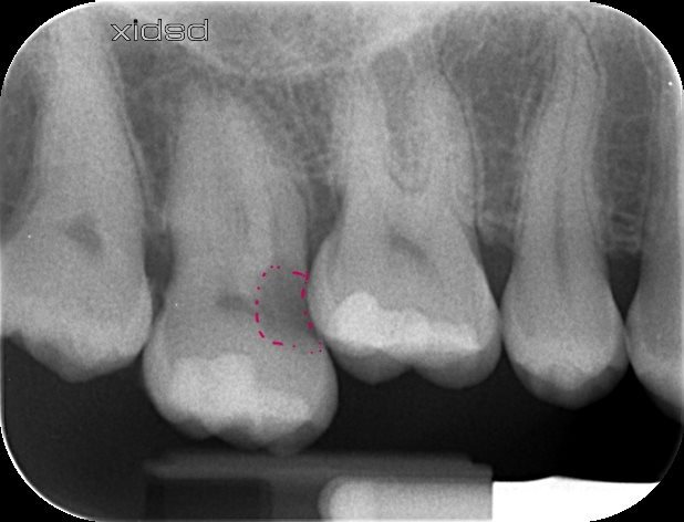 Radiographie montrant la migration de la dent hors de sa position d'origine