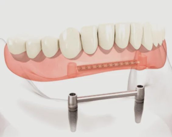 Prothèse complète inférieure stabilisée par une barre de conjonction reliant deux implants