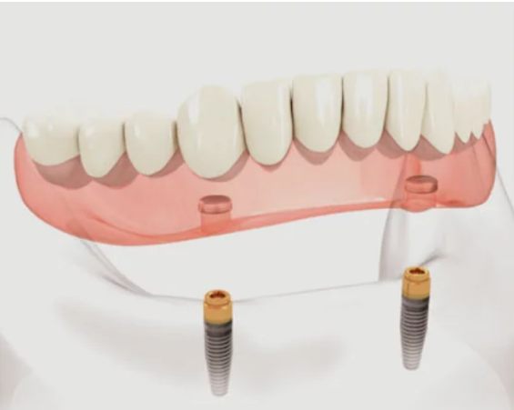 Prothèse complète inférieure stabilisée par deux implants à attachements boutons-pression
