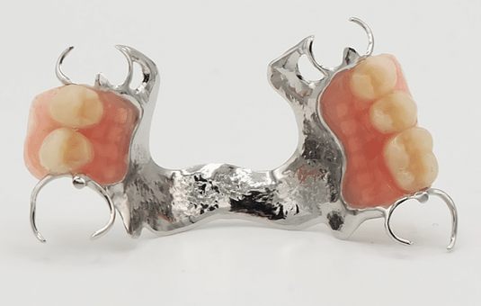 Prothèse squelettée mandibulaire : armature métallique, crochets et dents en résine
